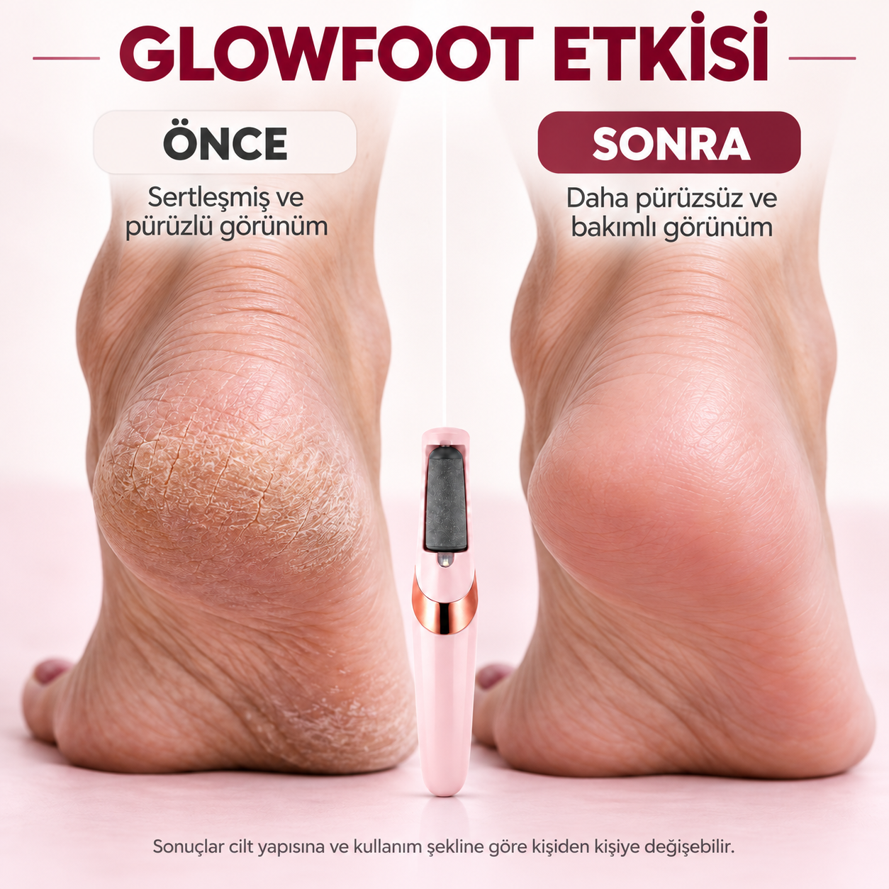 Glowfoot öncesi ve sonrası topuk görünümü karşılaştırması